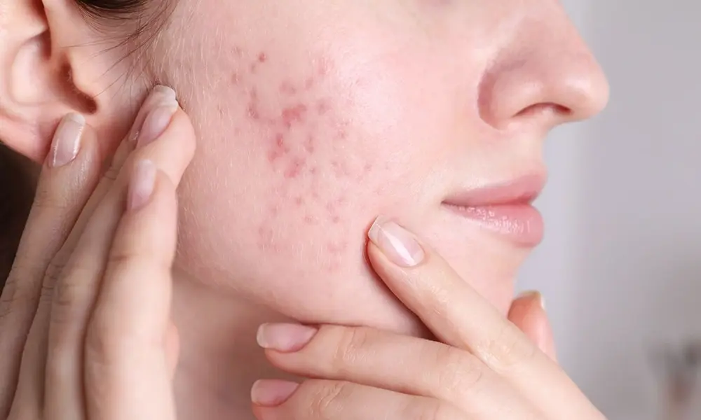 قرمزی و جای جوش های باقی مانده روی گونه یک خانم 