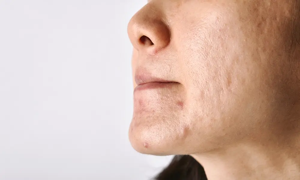 اسکار های جای جوش روی کل صورت یک خانم 