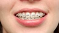 هزینه های سنگین ارتودنسی بر سلامتی بدن