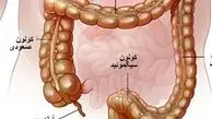  ۳ معجزه‌ گیاهی برای درمان «کولیت»