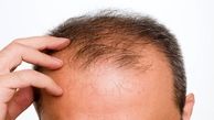 علت ریزش موی شدید چیست؟