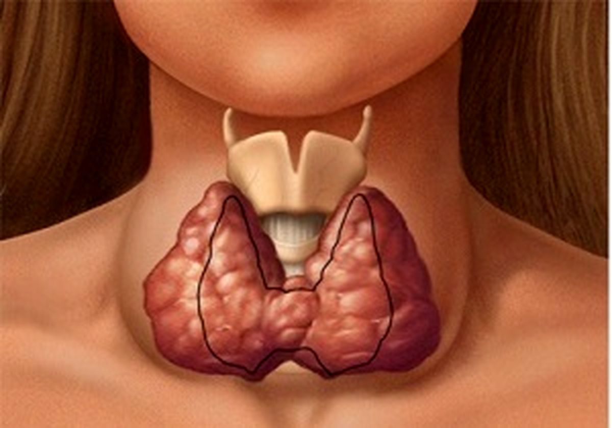 غذاهای موثر برای جلوگیری از کمبود ید در بدن