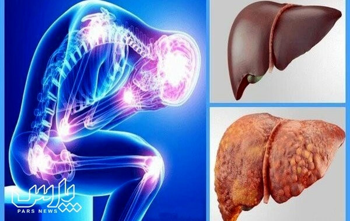 علائم کبد چرب و راه های درمان آن