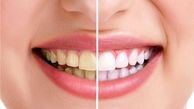 دلیل اصلی زرد شدن رنگ دندان چیست؟
