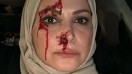 صورت زخمی و پُر از خون خانم بازیگر + عکس