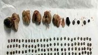 خروج بیش از 150 تکه سنگ از کلیه یک بیمار/تصویر