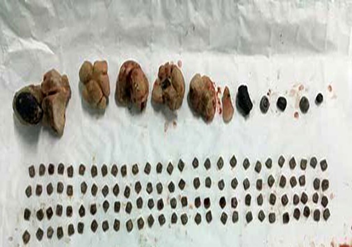 خروج بیش از 150 تکه سنگ از کلیه یک بیمار/تصویر