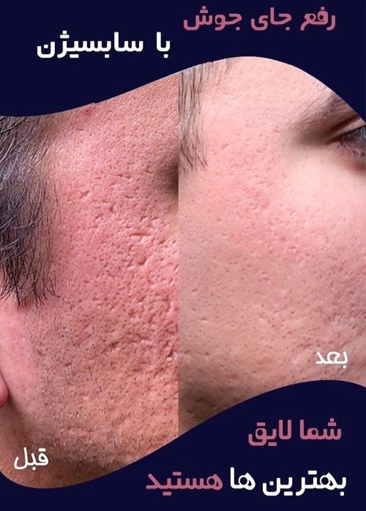 کلینیـک زیبایـی الیزه‌ لانژه؛ تاثیر سابسیژن بر رفع جای جوش