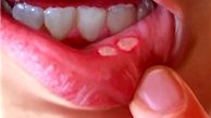 علت بروز آفت دهان چیست؟