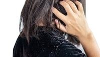 رفع شوره سر با نمک و 20 ماسک خانگی بدون بازگشت