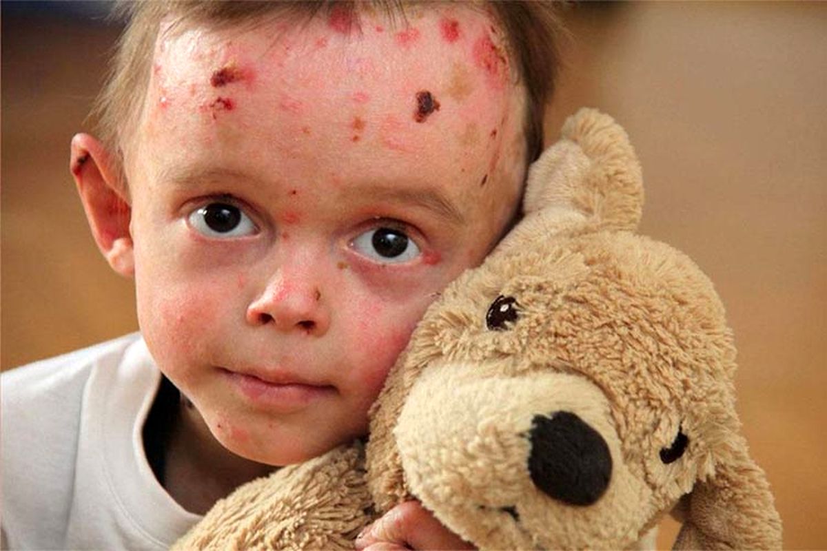 چگونه می‌توانیم به بیماران ای بی کمک کنیم؟