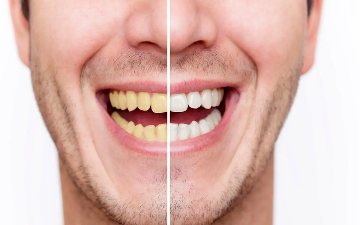 راه های جلوگیری از زردی دندان ها