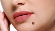 چه خال‌هایی خطرناک هستند؟