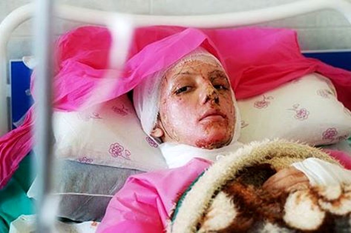 نتيجه يك پژوهش در مورد ميزان جراحي هاي زيبايي در ايران و آمريكا/ امكان پيوند صورت براي آسيب ديدگان اسيدپاشي