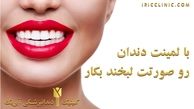 انواع لمینت دندان و قیمت (قیمت لمینت دندان 1400)