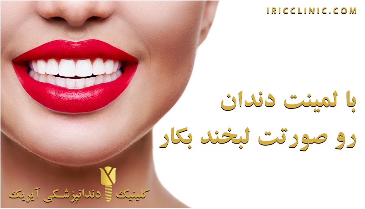 انواع لمینت دندان و قیمت (قیمت لمینت دندان 1400)