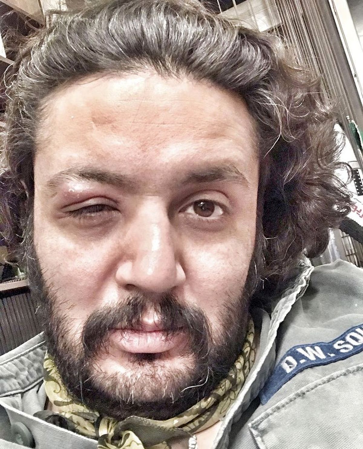 چشم بازیگر مشهور زخمی شد + عکس