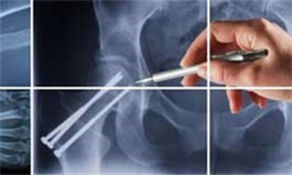 راه‌اندازی قطب‌های ارتوپدی تروما در کشور