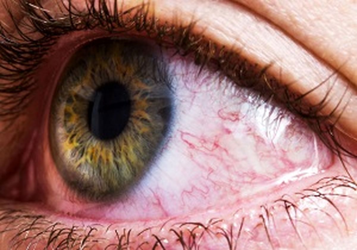 دلایل قرمزی و خارش پلک 