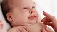 چرا برخی کودکان دچار خونریزی از بینی می شوند؟
