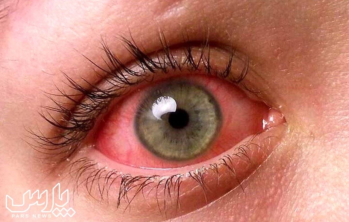 علت قرمز شدن چشم چیست؟ دلیل های قرمزی چشم