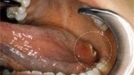  علائم و نشانه‌های سرطان حفره دهان