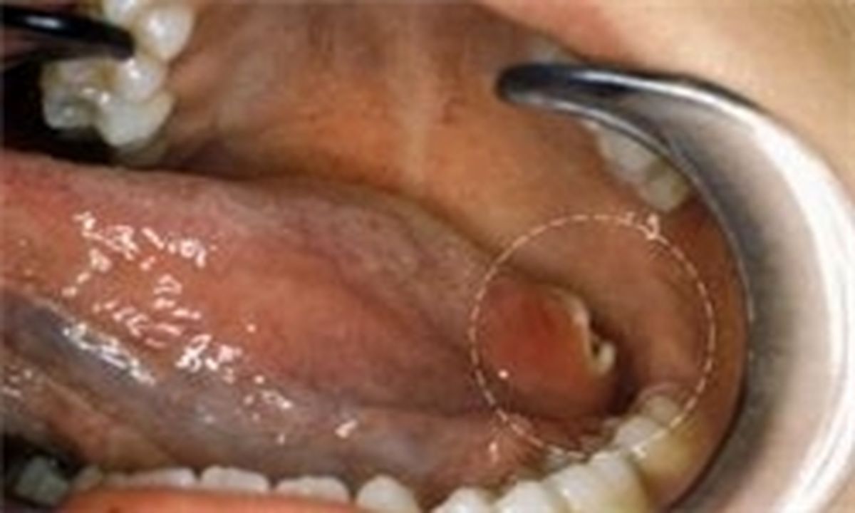  علائم و نشانه‌های سرطان حفره دهان
