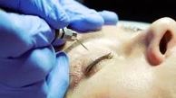 دانستنی‌هایی درباره جراحی زیبایی پلک