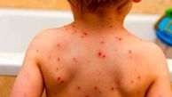 بیماری زونا چیست و چگونه منتقل می شود؟
