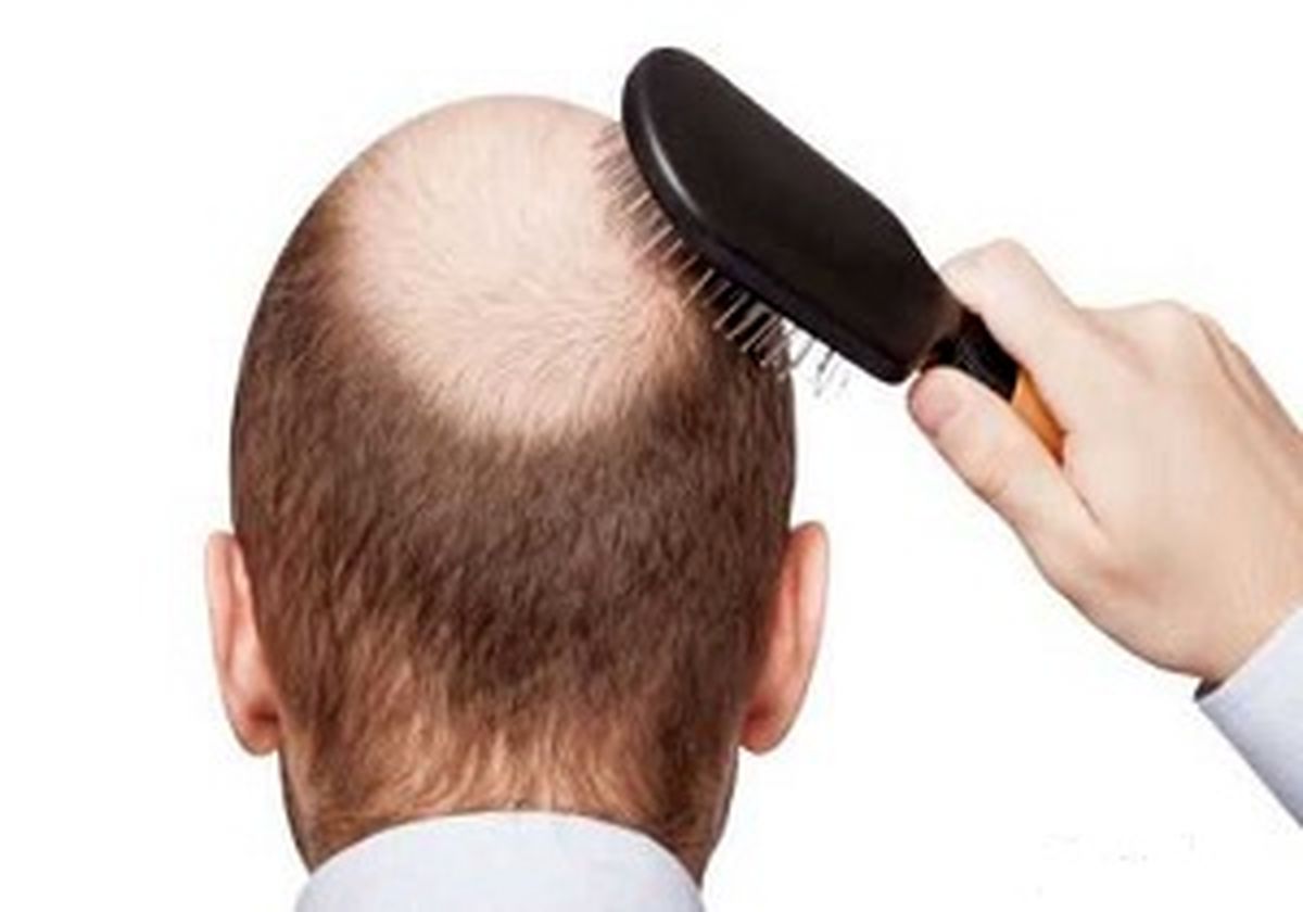 جلوگیری کردن از ریزش مو با یک درمان طبیعی 