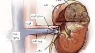دلایل بروز بیماری مثانه عصبی