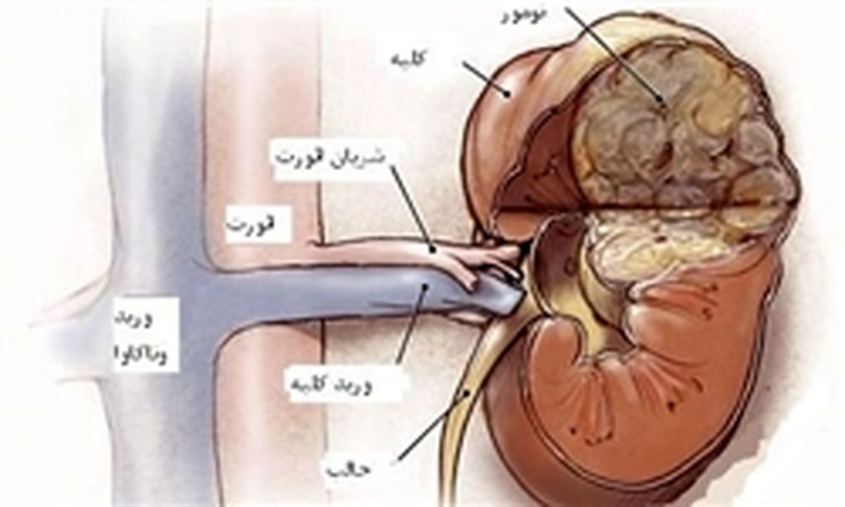دلایل بروز بیماری مثانه عصبی