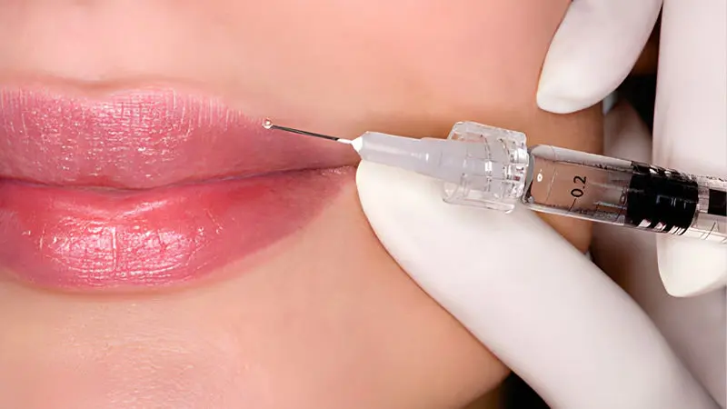 تزریق ژل لب روسی در شیراز