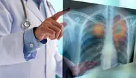 تشخیص زودهنگام سرطان ریه با کمک یک قطره خون!