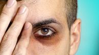 
چرا زیر چشم‌ ها تیره میشه؟
