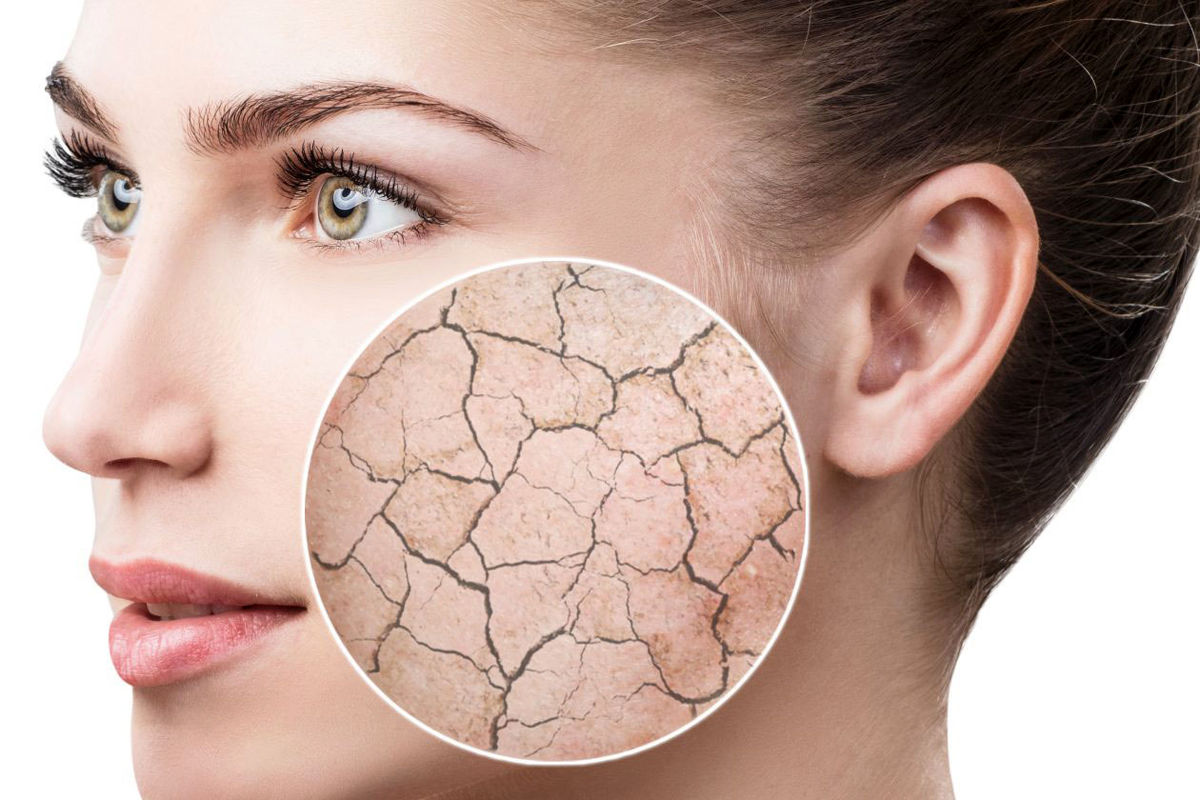 خشکی پوست در زمستان چه دلایلی دارد ؟
