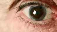 با نگاهی دقیق به چشمانتان از سرطان جلوگیری کنید