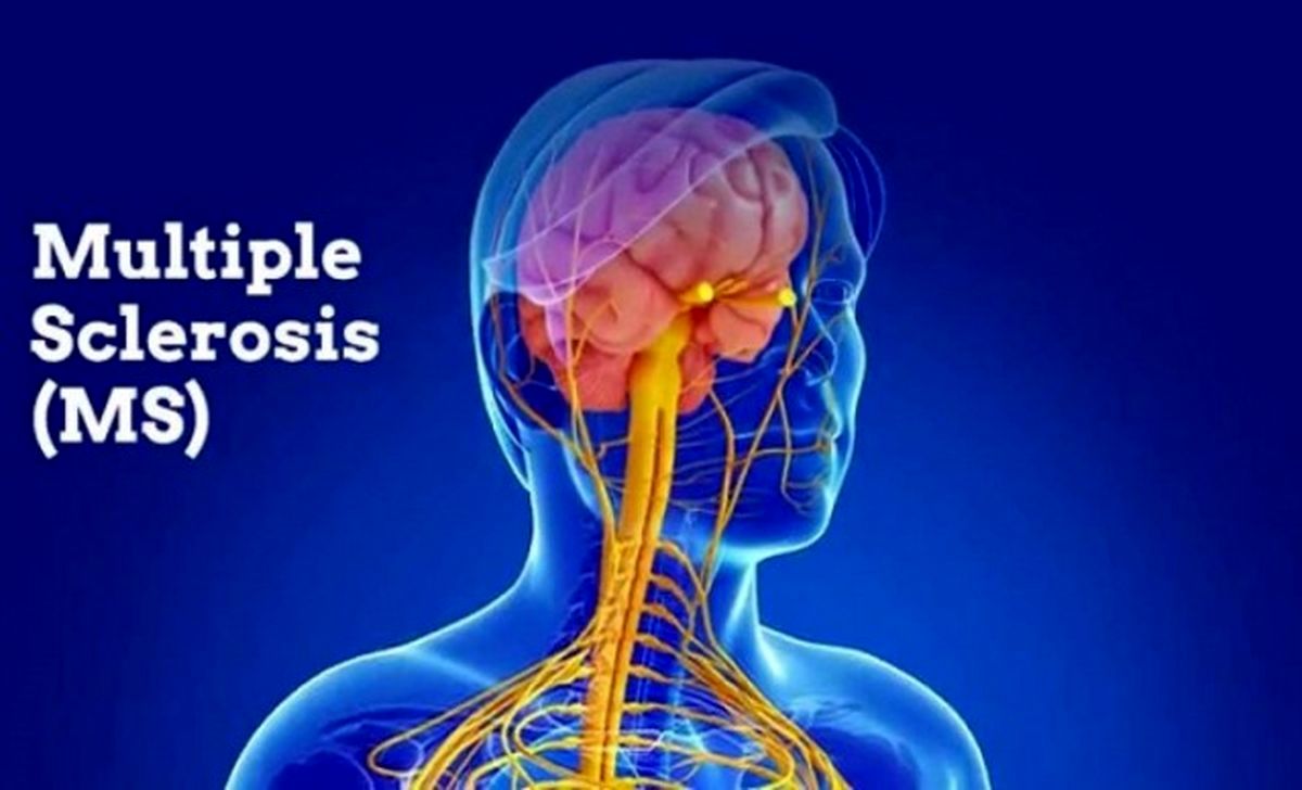 پیشگیری از ابتلا به ام اس با نور خورشید