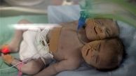تولد نوزاد دو سر در غزه +تصاویر