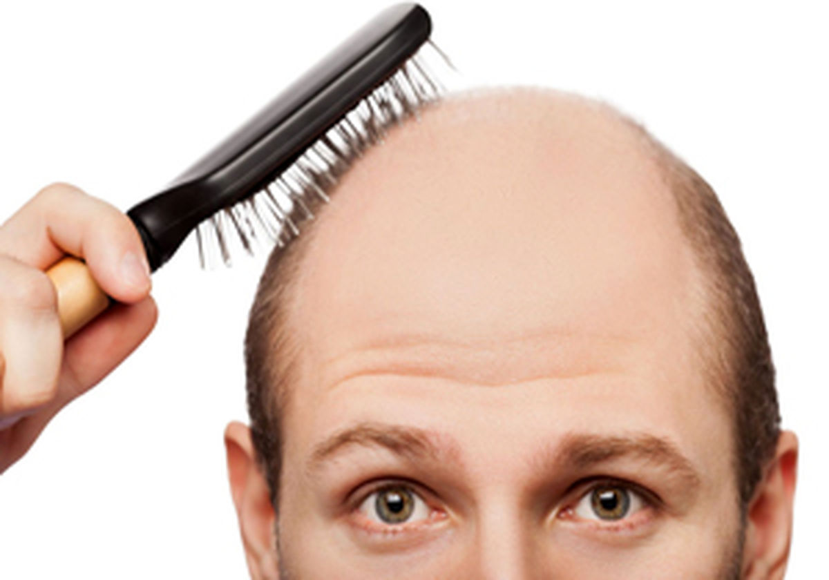 ریزش موهای چرب را چگونه درمان کنیم؟