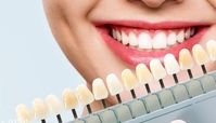 فرق کامپوزیت و لمینیت دندان چیست ؟ کدام بهتر و با دوام تر است؟