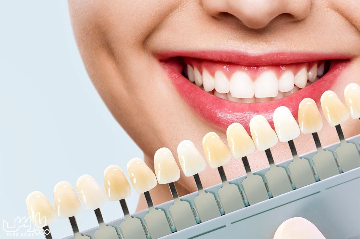فرق کامپوزیت و لمینیت دندان چیست ؟ کدام بهتر و با دوام تر است؟