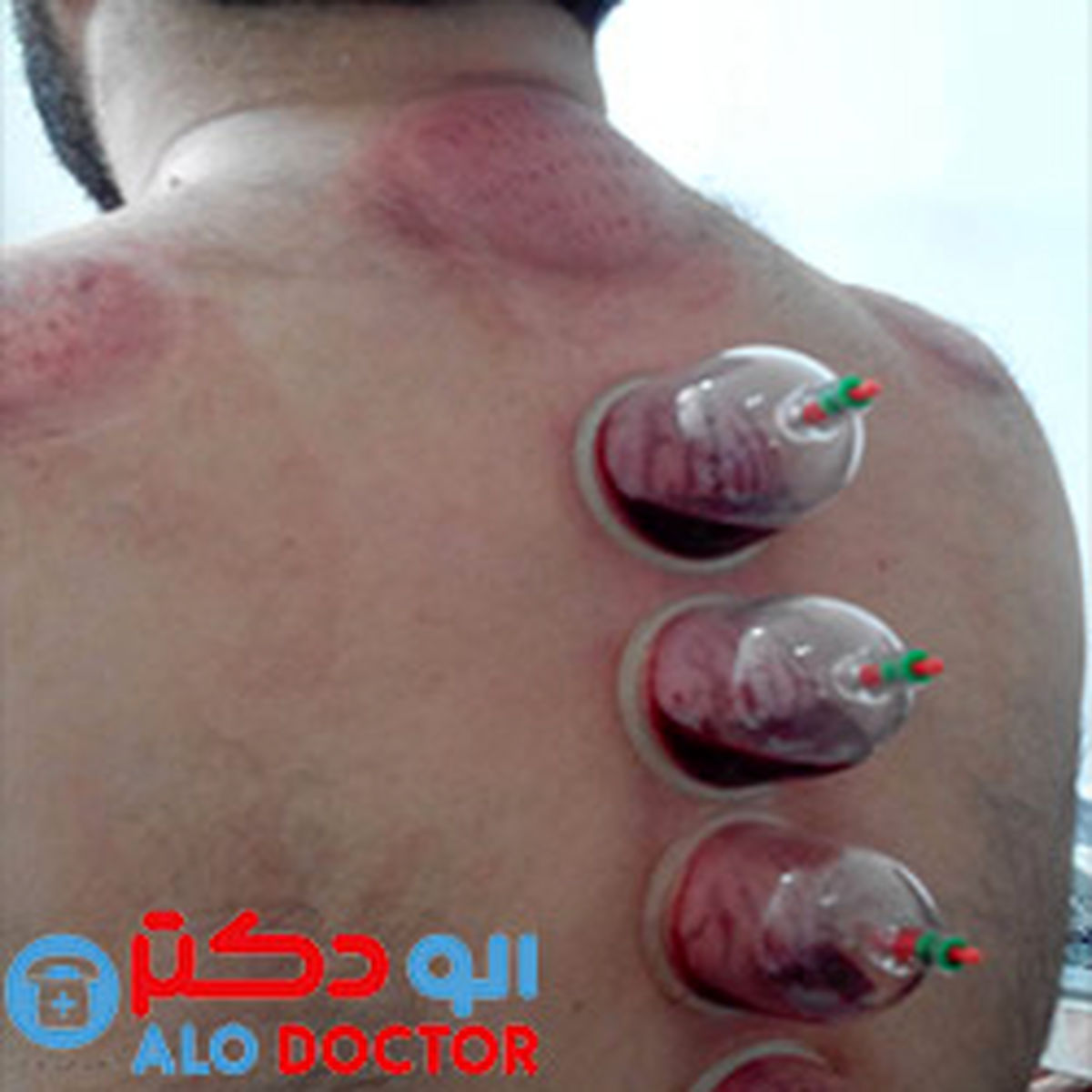 به جای حجامت این کار را بکنید!