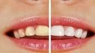 بایدها و نبایدهای سفید کردن دندان‌ها 