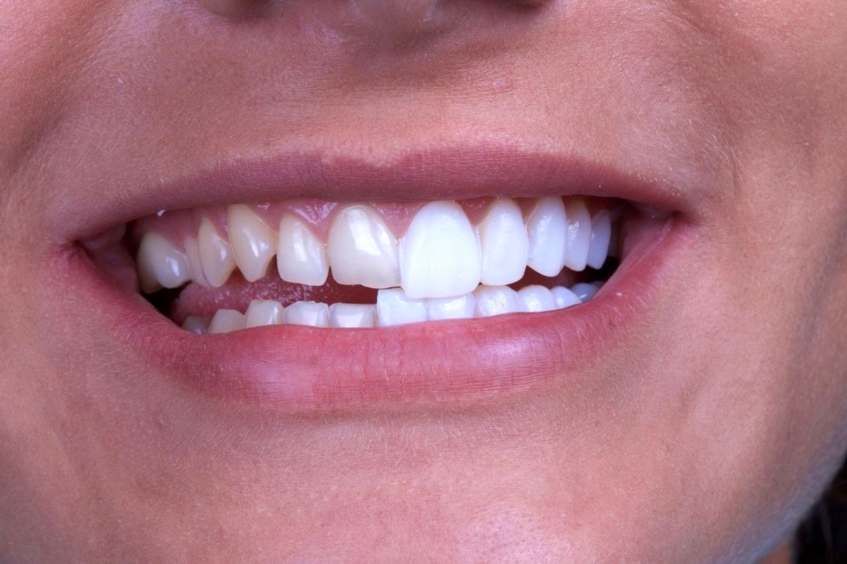 لومینیرز دندان در جنت آباد 