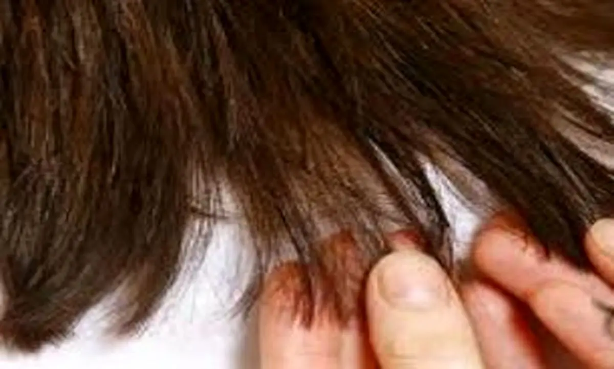 چند شاخه شدن مو را جدی بگیریم 
