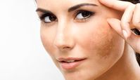 راهکار حذف لکه‌های قهوه‌ای ناشی از آفتاب روی پوست