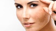 راهکار حذف لکه‌های قهوه‌ای ناشی از آفتاب روی پوست