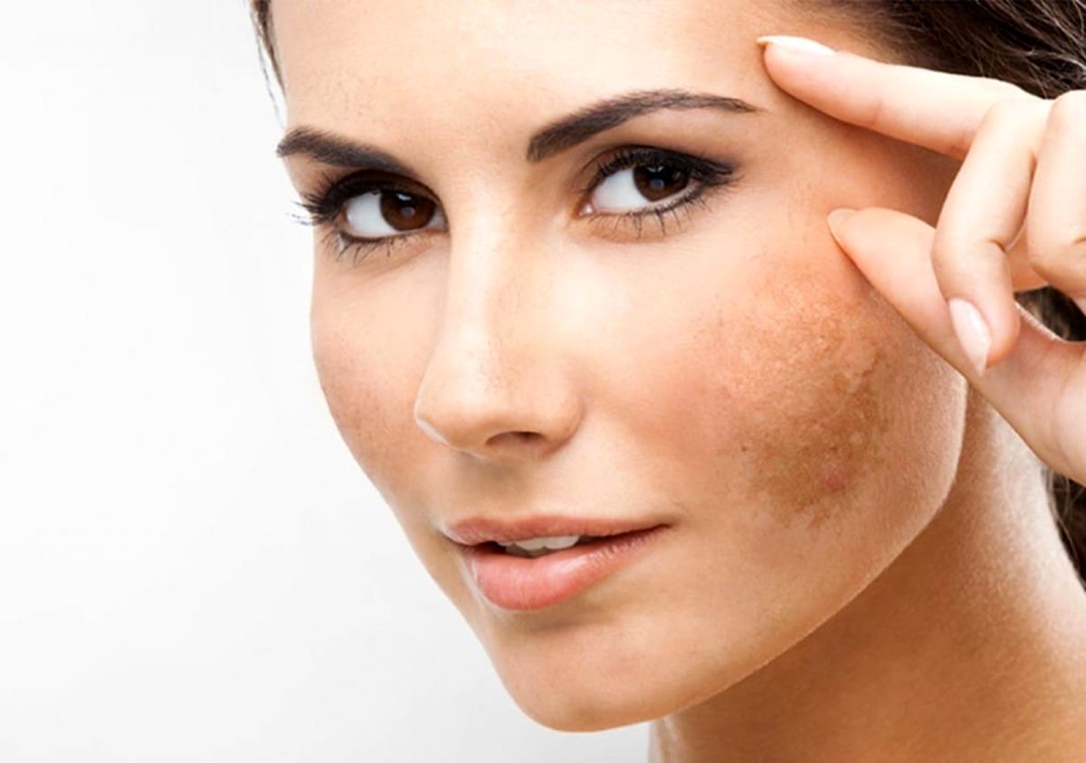 راهکار حذف لکه‌های قهوه‌ای ناشی از آفتاب روی پوست