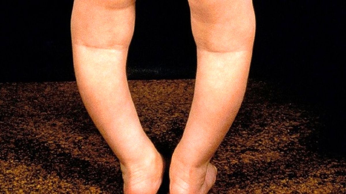 همه‌چیز درباره زانو‌های پرانتزی در کودکان
